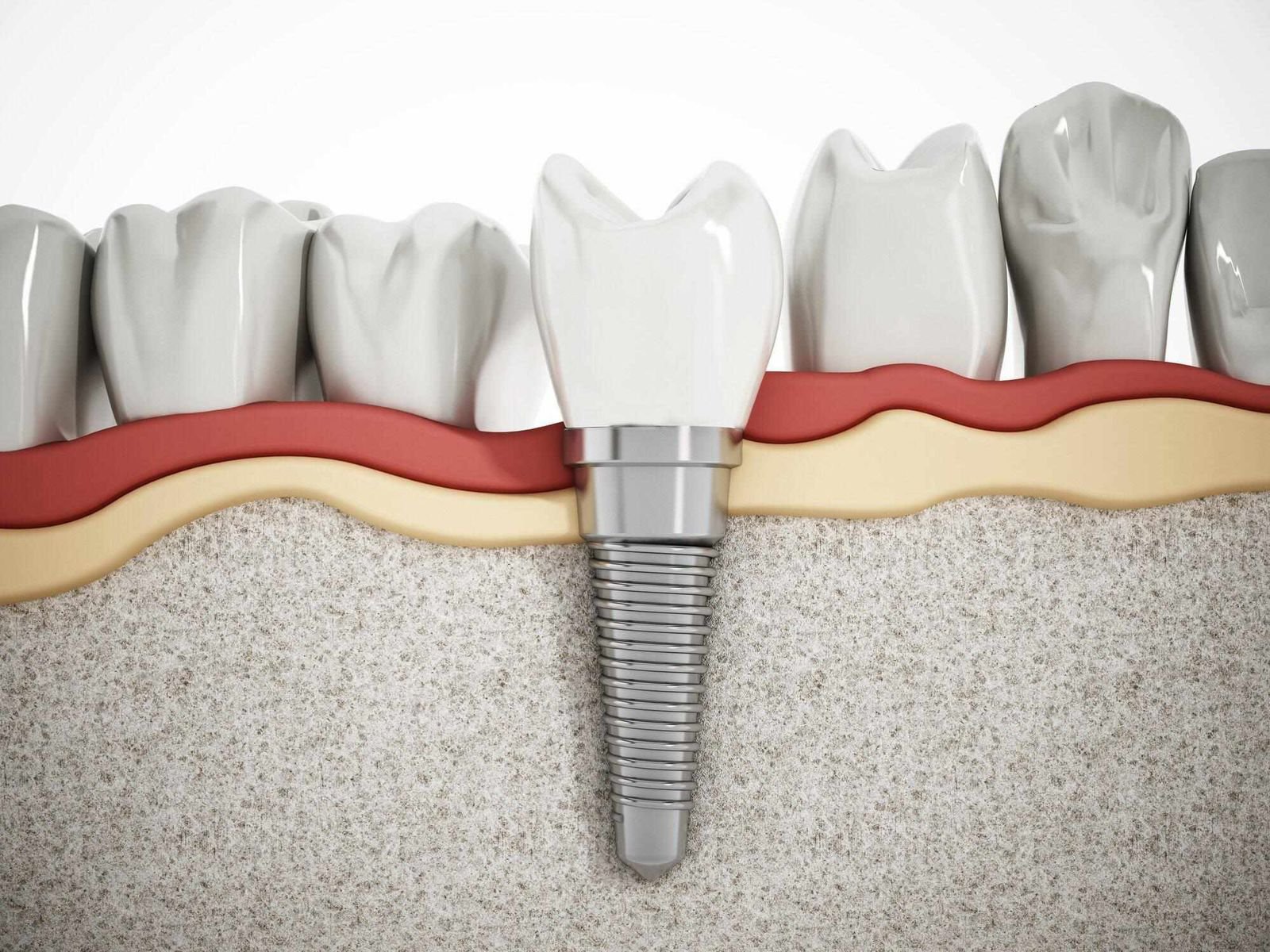 Understanding the Cost of Dental Veneers: What You Need to Know