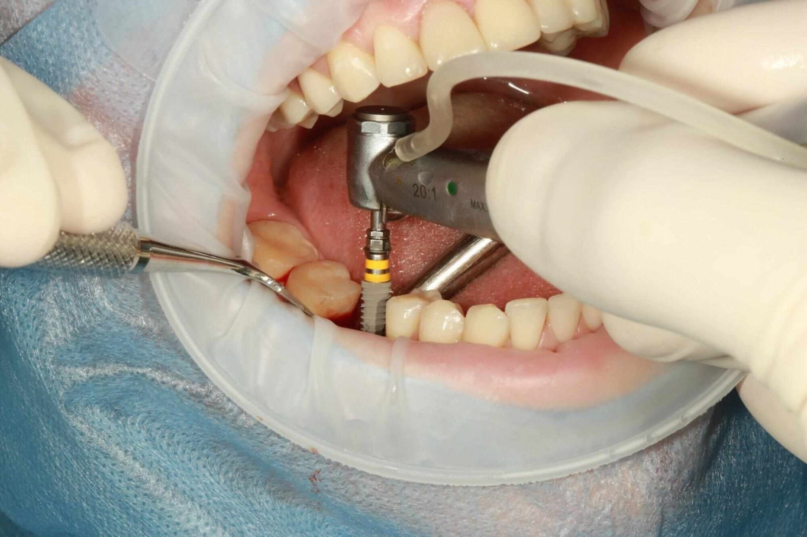 How All on Four Dental Implants Can Transform Your Oral Health