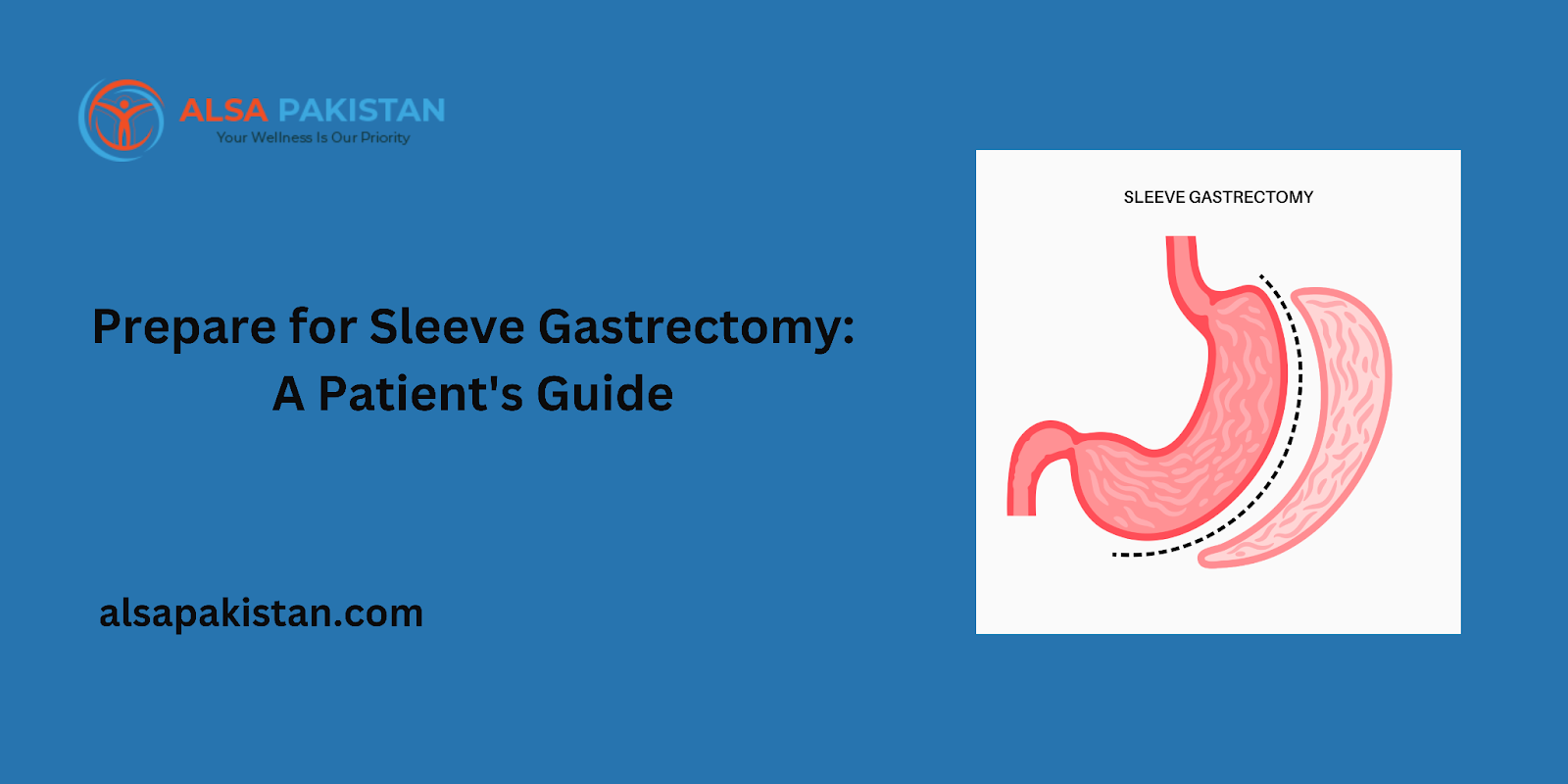 Prepare for Sleeve Gastrectomy: A Patient's Guide